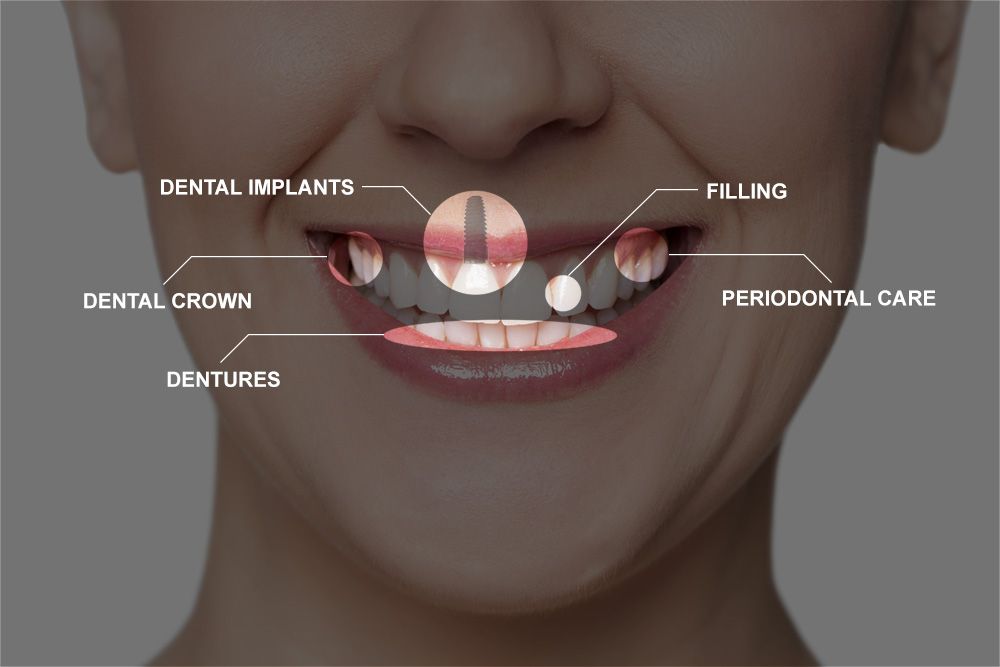 Full Mouth Reconstruction Patient