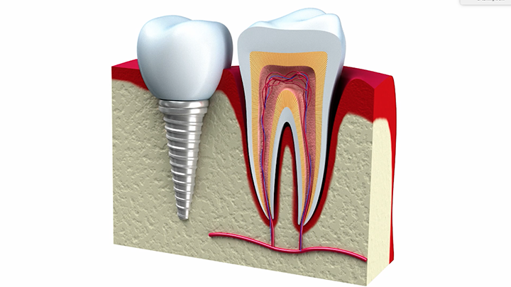 Dental Implants