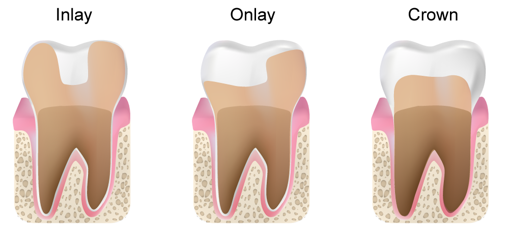 inlay and onlay and crown