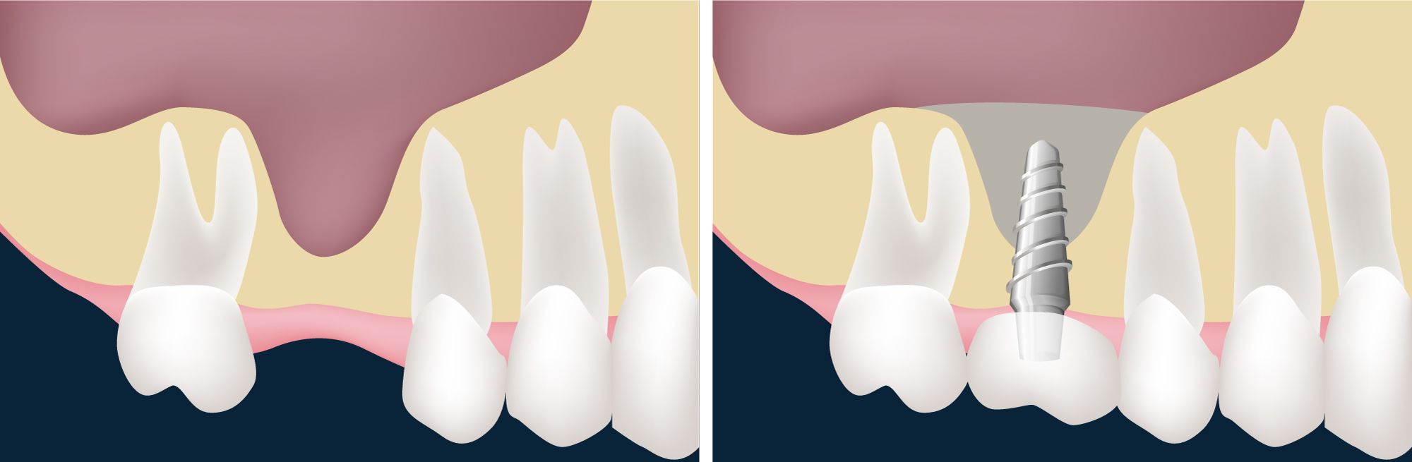 dental implant surgery image 2