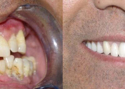 Dental Implants Case 1