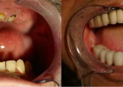 Dental implants case 2