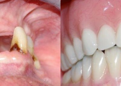 Dental Implants Case 3