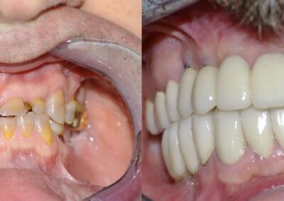 Dental Implants Case 4