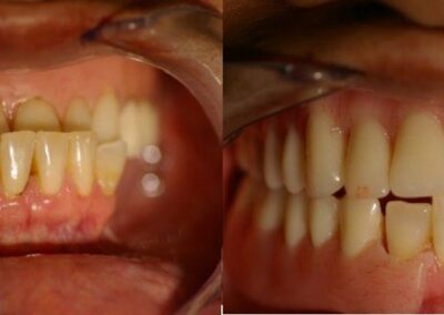 Dentures Case 1