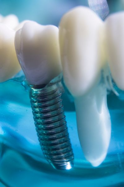 dental implant lower jaw